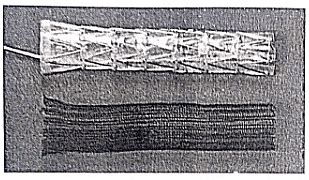 Carcinoma Esophagus - Medical Science Optional Notes for UPSC PDF Download