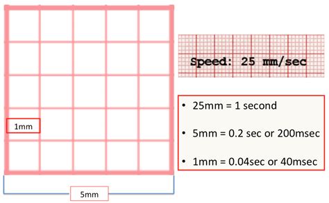 ECG Basics - REBEL EM - Emergency Medicine Blog