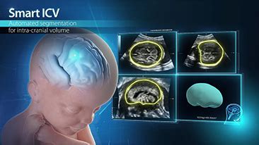 [Official] Obstetrics and Gynecology Solution - Nuewa Series - Mindray ...