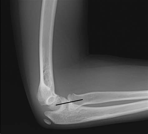 Nursemaid's Elbow Pain Location at Rachel Shortland blog