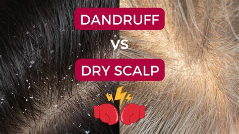 Scalp Dandruff 的图像结果
