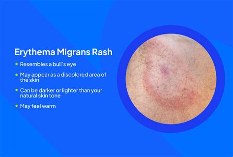 Lyme Disease: Signs and Symptoms