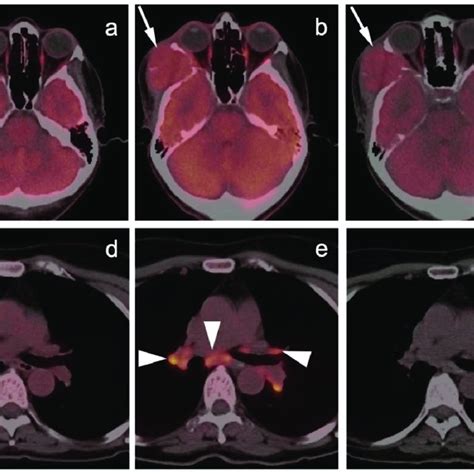 Image result for DOTA-TATE Scan