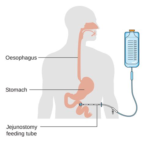 A feeding tube is a gadget that is embedded into your stomach through ...
