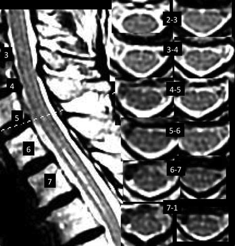 MRI T2-Hyperintense Signal Structures in the Cervical Spinal Cord ...