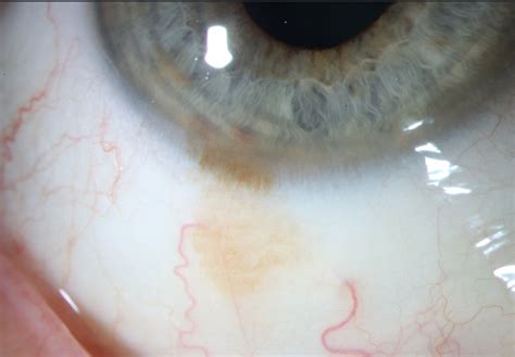 Atlas Entry - Primary acquired melanosis (PAM)