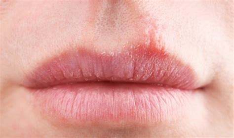 唇周边长痘怎么办 正确护理肌肤的方法_腾讯新闻
