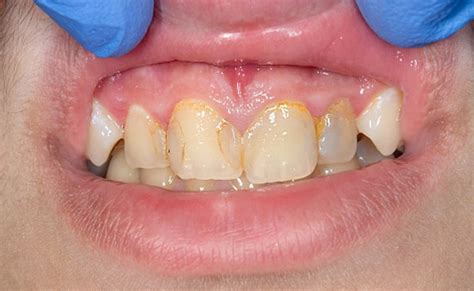 How to get rid of yellow teeth: पीले दांतों को सफेद कैसे करें, तुलसी के ...