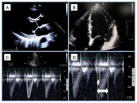 Development and Clinical Application of Left Ventricular–Arterial ...