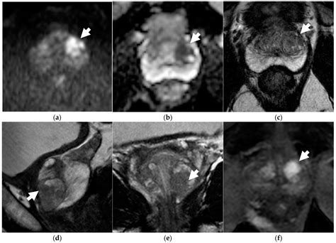 Abbreviated Versus Multiparametric Prostate MRI in Active Surveillance ...