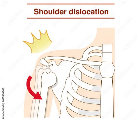 Shoulder Dislocation Contortion 的图像结果