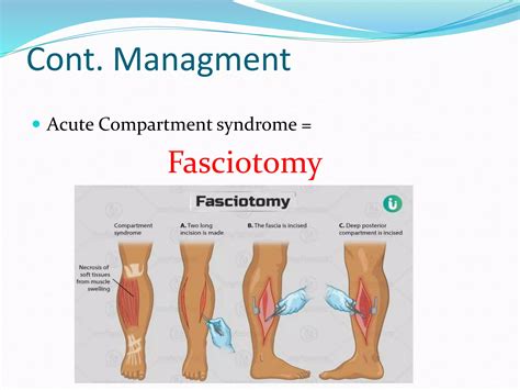 Compartment Syndrome 5 Ps