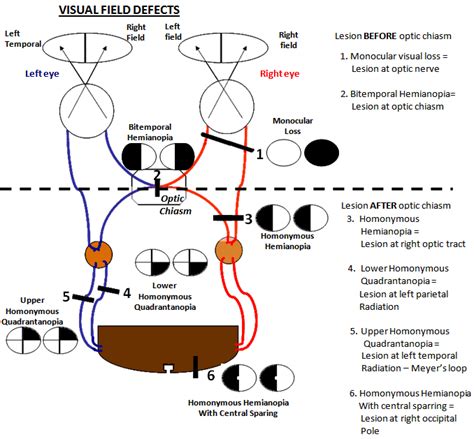Visual Field Defects Explained 的图像结果