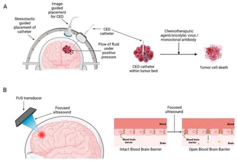 Medical Device Advances in the Treatment of Glioblastoma