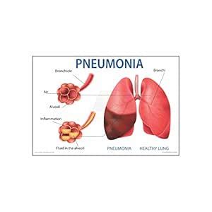 Anne Print Solutions® Pneumonia symptoms Chart Posters For Hospital ...