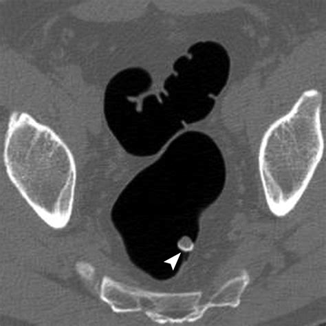 How Do They Do A Ct Colonography at Amy Yates blog
