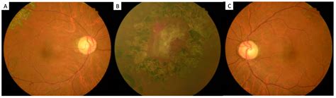 Polycythemia-Related Proliferative Ischemic Retinopathy Managed with ...