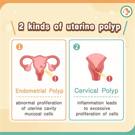 Uterine Polyp Removal