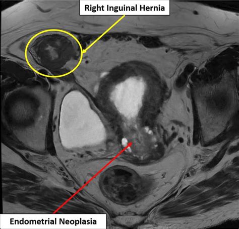 Ovarian Hernia Inguinalepptx Inguinal Hernia NIDDK