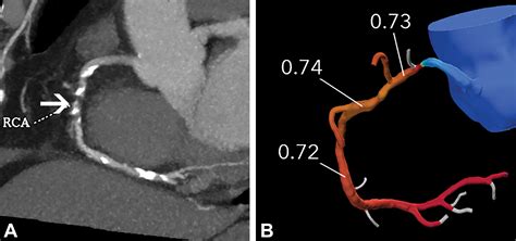 CT Fractional Flow Reserve: A Practical Guide to Application ...