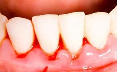 镶牙后牙龈出血的原因是什么-爱康健齿科