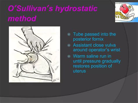 Inversion Of Uterus | PPTX