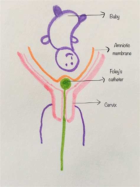 How Long Does A Balloon Induction Take at Emerita Yamamoto blog