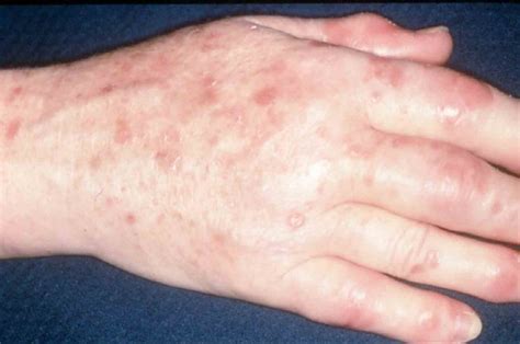 Psoriatic arthritis is an inflammatory joint condition associated with psoriasis