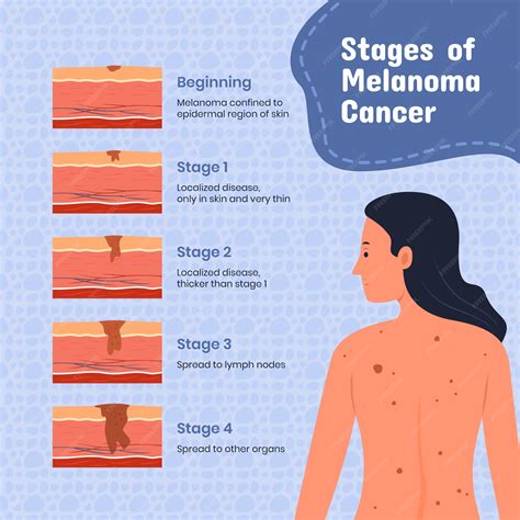 Melanoma Stage 2
