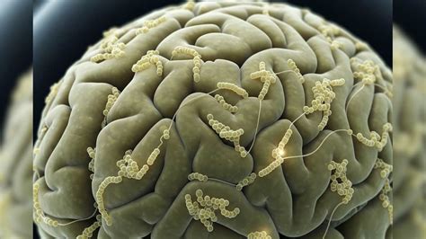 Brain-Affecting Tapeworm Infections: ফিতাকৃমির ডিম উঠে যাচ্ছে মাথায় ...