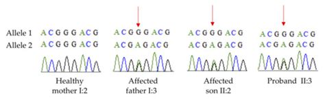 Novel Mutation in CRYBB3 Causing Pediatric Cataract and Microphthalmia