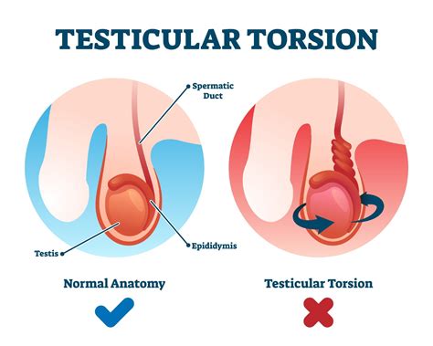 Testicular Pain Causes