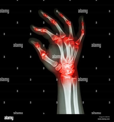 What Does Arthritis Look Like On Hands at Sabrina Evans blog