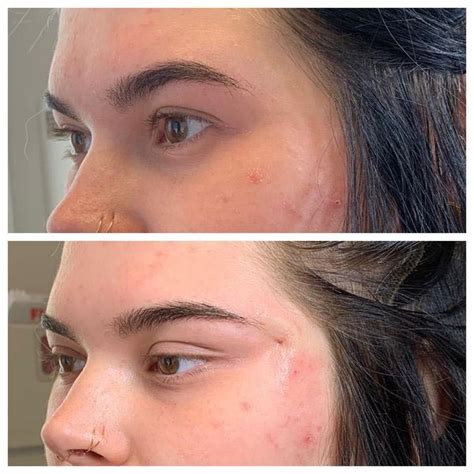 Image result for Fox Eye Thread Lift Procedure