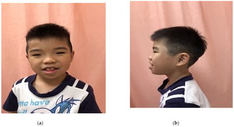 Wiedemann–Steiner Syndrome with a Pathogenic Variant in KMT2A from Taiwan