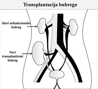 Transplantacija bubrega | Kidney Transplantation in Serbian