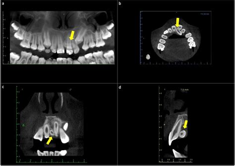 Non-Syndromic Familial Mesiodens: Presentation of Three Cases