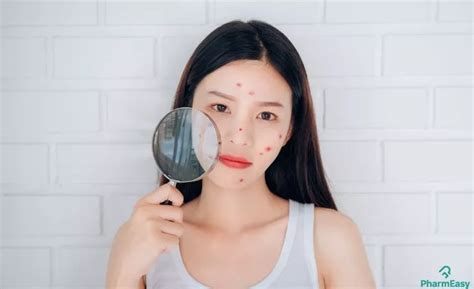 How to Treat Acne Naturally: Causes, Types & Best Homemade Face Masks ...