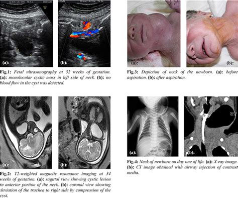 Pyriform Sinus Fistula Presenting as Fetal Cervical Cyst