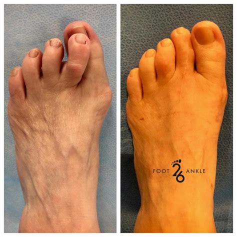 Image result for Toe Surgery