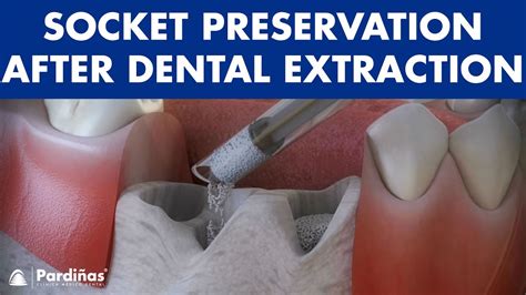 Tooth Socket After Extraction 的图像结果