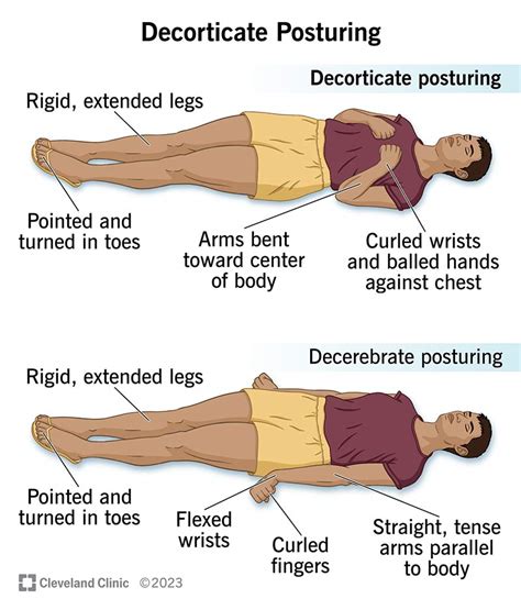 Image result for Decorticate Posture