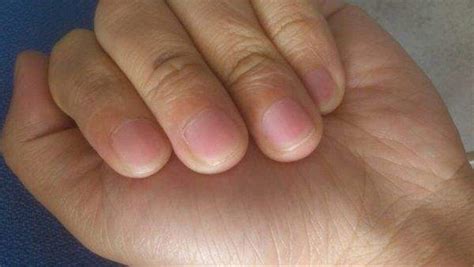 灰指甲前期长什么样子，18张照片看清灰指甲是如何去除的全过程 - 知乎