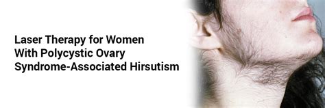 Laser Therapy for Women With Polycystic Ovary Syndrome-Associated Hirsutism