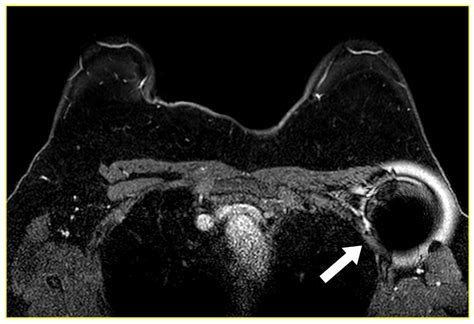 Image-Guided Localization Techniques for Metastatic Axillary Lymph ...