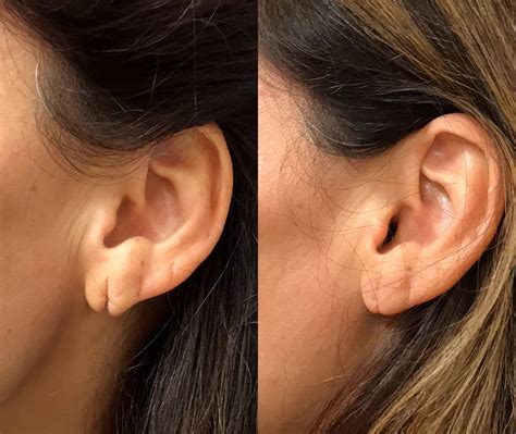 Before & After Photos Earlobe Repair 3 | NYC