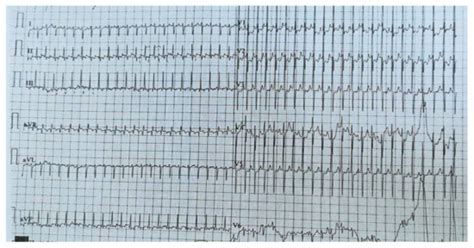 Paroxysmal Supraventricular Tachycardia in Wolff–Parkinson–White ...
