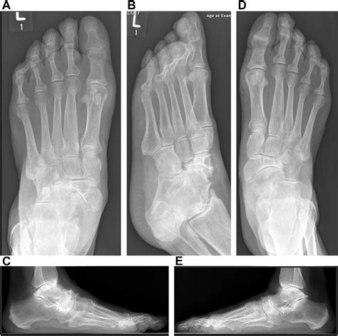 Classification Systems in Müller-Weiss Disease - Foot and Ankle Clinics