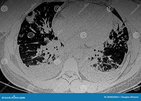 Chest CAT SCAN of Multiple Infections of Lungs. Stock Image - Image of healthcare, tomography ...
