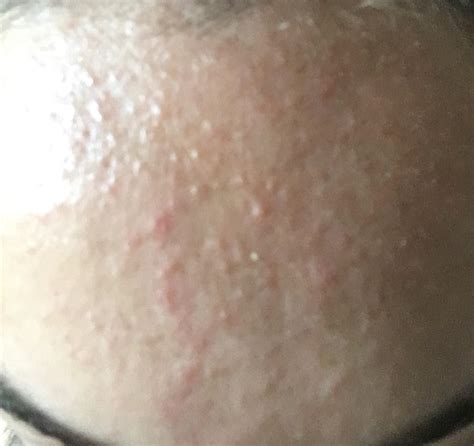 [routine help] for little red bumps on forehead : r/SkincareAddiction